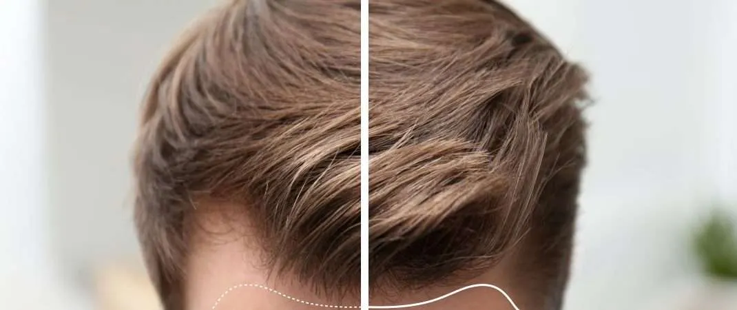 La creatina te hace caer el pelo ¿es verdad?